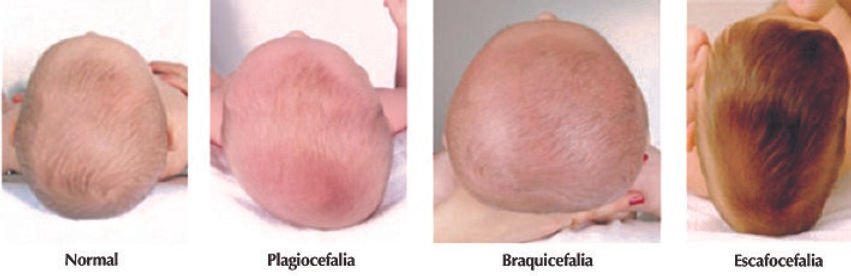 Imagine pentru articolul „Tratamentul Osteopatic al Plagiocefaliilor”
